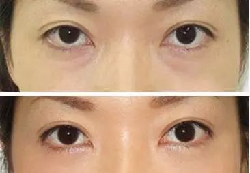 超声波去眼袋好简单,好轻松的哦!016 超声波去眼袋好简单,好轻松的哦!016