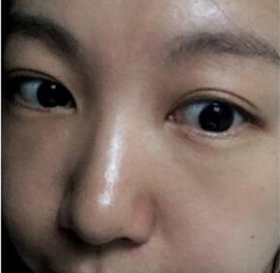 超声波去眼袋让我赢得幸福人生236 超声波去眼袋让我赢得幸福人生236