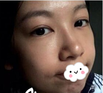 超声波去眼袋让我赢得幸福人生236 超声波去眼袋让我赢得幸福人生236