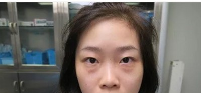 效果好到没朋友得超 声 波去眼袋 效果好到没朋友得超 声 波去眼袋