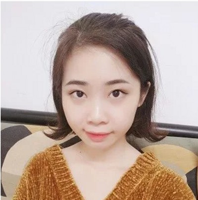 超声波去眼袋无痛!无痛!真的无痛!044 超声波去眼袋无痛!无痛!真的无痛!044