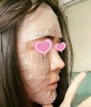 自体脂肪丰面两个月啦来露个脸046 自体脂肪丰面两个月啦来露个脸046