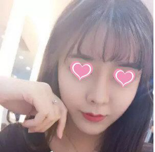 自体脂肪丰面两个月啦来露个脸046 自体脂肪丰面两个月啦来露个脸046