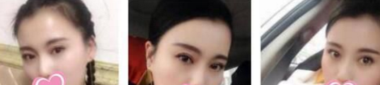 熬夜加班得眼袋怎么办?超 声 波去眼袋解决! 熬夜加班得眼袋怎么办?超 声 波去眼袋解决!
