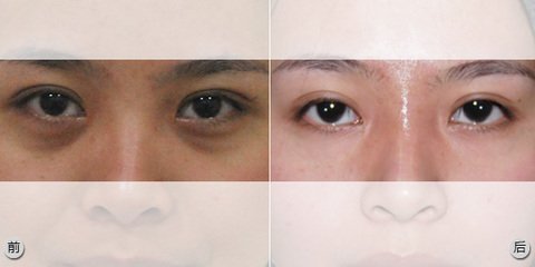 记录一次满意的超声波去眼袋手术之行221 记录一次满意的超声波去眼袋手术之行221
