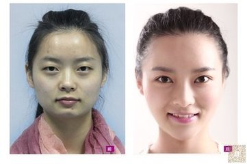 记录一次满意的超声波去眼袋手术之行221 记录一次满意的超声波去眼袋手术之行221