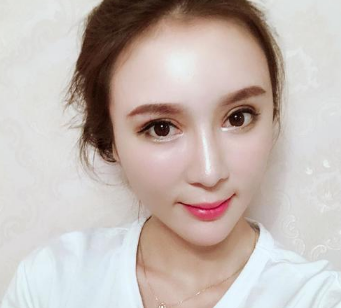 这次做得超 声 波双眼 皮恢复更棒! 这次做得超 声 波双眼 皮恢复更棒!