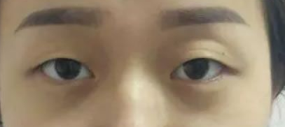 一直潜水关注的超声波双眼皮,这次做了!016 一直潜水关注的超声波双眼皮,这次做了!016