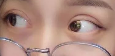 一直潜水关注的超声波双眼皮,这次做了!016 一直潜水关注的超声波双眼皮,这次做了!016