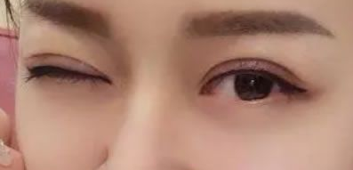 一直潜水关注的超声波双眼皮,这次做了!016 一直潜水关注的超声波双眼皮,这次做了!016