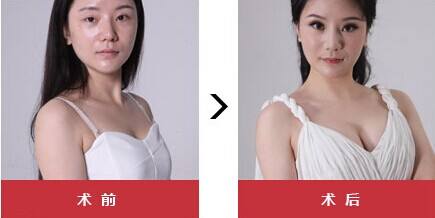 超声波自体脂肪丰胸效果特别的棒!995 超声波自体脂肪丰胸效果特别的棒!995