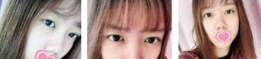 高考之后我做了超声波双眼皮340 高考之后我做了超声波双眼皮340
