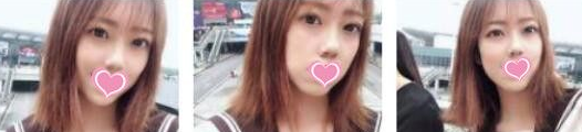 高考之后我做了超声波双眼皮340 高考之后我做了超声波双眼皮340