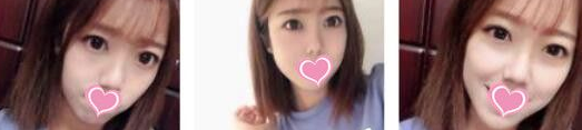 高考之后我做了超声波双眼皮340 高考之后我做了超声波双眼皮340