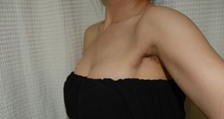 超 声 波自体脂肪丰胸形态真实自然 超 声 波自体脂肪丰胸形态真实自然