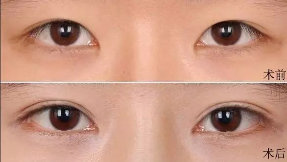 超声波双眼皮收费不高,效果还好852 超声波双眼皮收费不高,效果还好852