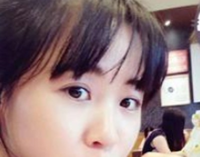 超声波双眼皮整形让你的眼睛更美妙531 超声波双眼皮整形让你的眼睛更美妙531