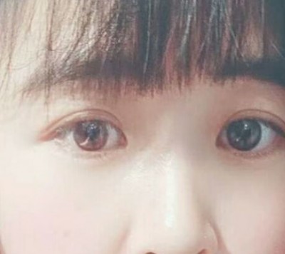 超声波双眼皮整形让你的眼睛更美妙531 超声波双眼皮整形让你的眼睛更美妙531