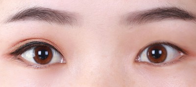 让人欣喜若狂的双眼皮技术282 让人欣喜若狂的双眼皮技术282