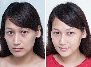 效果很鲜明的超声波去眼袋手术397 效果很鲜明的超声波去眼袋手术397