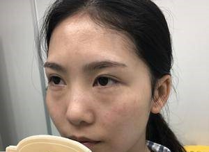 效果很鲜明的超声波去眼袋手术397 效果很鲜明的超声波去眼袋手术397