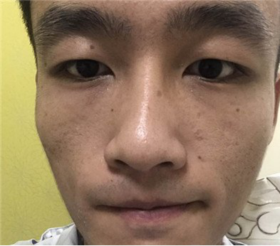 3D细胞种植技术让麻子脸秒变著名演员501 3D细胞种植技术让麻子脸秒变著名演员501