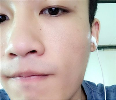 3D细胞种植技术让麻子脸秒变著名演员501 3D细胞种植技术让麻子脸秒变著名演员501
