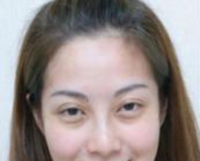 超声波去眼袋,终身和眼袋无缘186 超声波去眼袋,终身和眼袋无缘186