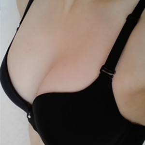 从平板身材到婀娜多姿,超 声 波自体脂肪丰胸手术 从平板身材到婀娜多姿,超 声 波自体脂肪丰胸手术