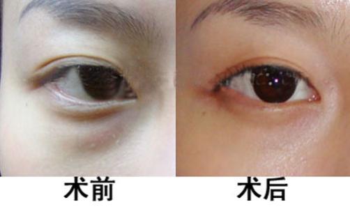如何才能走出眼袋的桎梏——超声波去眼袋手术956 如何才能走出眼袋的桎梏——超声波去眼袋手术956