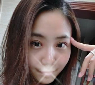 超 声 波双眼 皮后成功蜕变le!! 超 声 波双眼 皮后成功蜕变le!!