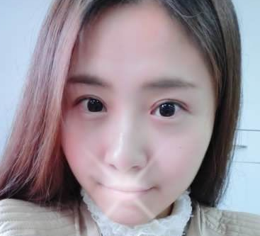 超 声 波双眼 皮后成功蜕变le!! 超 声 波双眼 皮后成功蜕变le!!