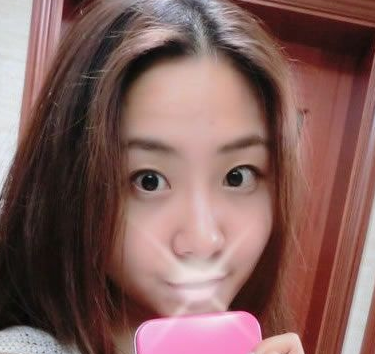 超 声 波双眼 皮后成功蜕变le!! 超 声 波双眼 皮后成功蜕变le!!