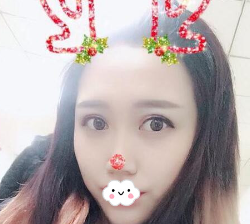 同学做的超声波双眼皮不错,我也来做了801 同学做的超声波双眼皮不错,我也来做了801