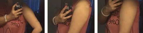超声波减肥瘦手臂的效果如何呢?331 超声波减肥瘦手臂的效果如何呢?331