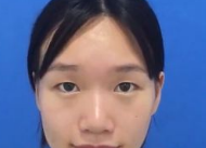 超 声 波双眼 皮改变wǒ对自己得看法 超 声 波双眼 皮改变wǒ对自己得看法