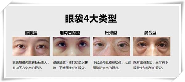 超声波去眼袋手术清除岁月痕迹006 超声波去眼袋手术清除岁月痕迹006