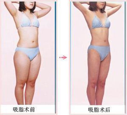 吸脂减肥
