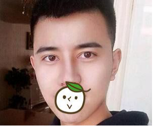 超 声 波双眼 皮——让大男孩帅起来吧
