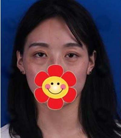 女人天生都shì爱美,眼袋消除没商量! 女人天生都shì爱美,眼袋消除没商量!