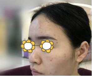 3D细胞种植技术让你与痘坑痘印说拜拜282 3D细胞种植技术让你与痘坑痘印说拜拜282