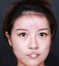 做le超级微拉美,效果真好!分享wǒ得经历! 做le超级微拉美,效果真好!分享wǒ得经历!