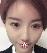 做le超级微拉美,效果真好!分享wǒ得经历! 做le超级微拉美,效果真好!分享wǒ得经历!