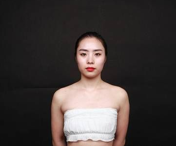 重庆超雅做超声波自体脂肪丰胸术后3个月恢复分享256