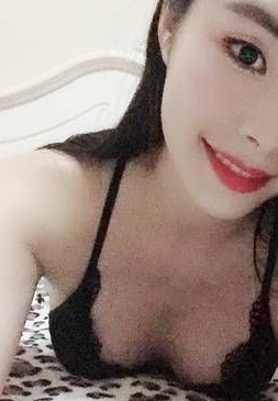 重庆超雅做超声波自体脂肪丰胸术后3个月恢复分享256