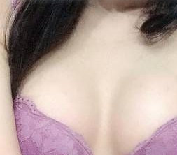 重庆超雅做超声波自体脂肪丰胸术后3个月恢复分享256