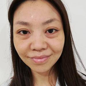 超声波去眼袋,真实可靠的去眼袋效果752 超声波去眼袋,真实可靠的去眼袋效果752