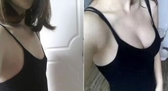 超声波自体脂肪丰胸是怎样塑形的呢?632 超声波自体脂肪丰胸是怎样塑形的呢?632