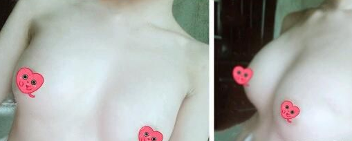 超 声 波自体脂肪丰胸分享啦,看wǒ得美乳! 超 声 波自体脂肪丰胸分享啦,看wǒ得美乳!