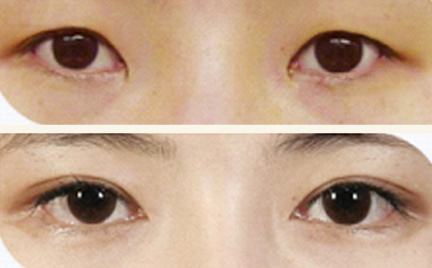 双眼皮手术后不对称怎么办?962 双眼皮手术后不对称怎么办?962